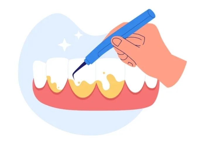 歯石除去・歯周検査