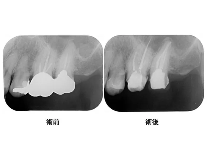 被せ物の治療