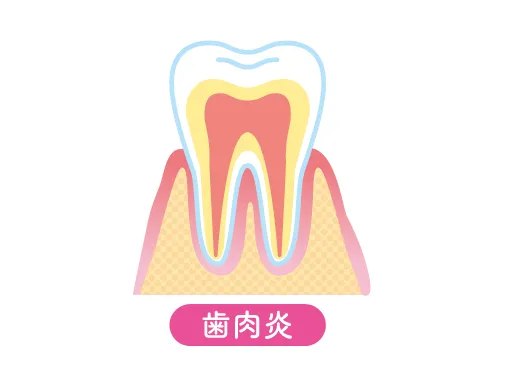 歯肉炎