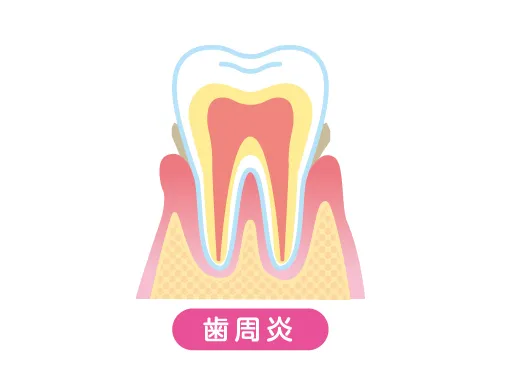 軽度歯周炎