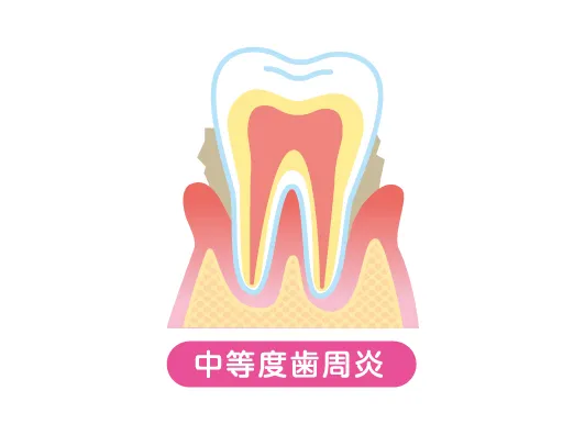 中等度歯周炎