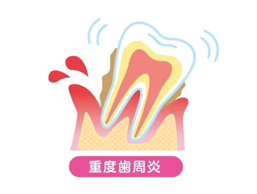 重度歯周炎